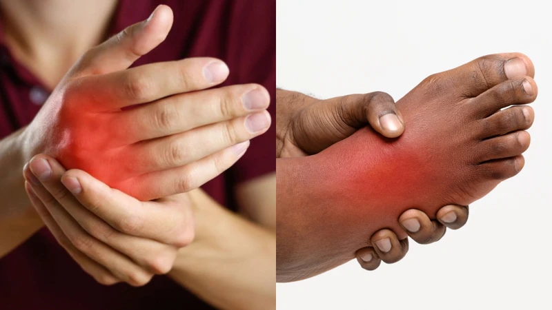 Biểu hiện của hội chứng Sudeck