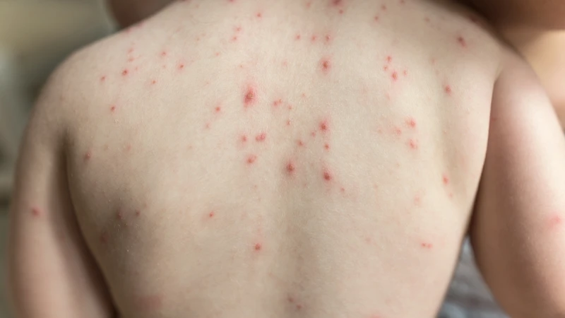Tiên lượng hội chứng thủy đậu bẩm sinh phụ thuộc mức độ tổn thương