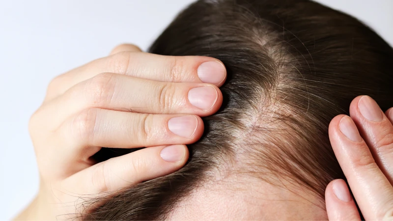 Hói đầu kiểu nữ thường rõ hơn sau mãn kinh, tóc vùng đỉnh thưa dần và đường ngôi rộng hơn