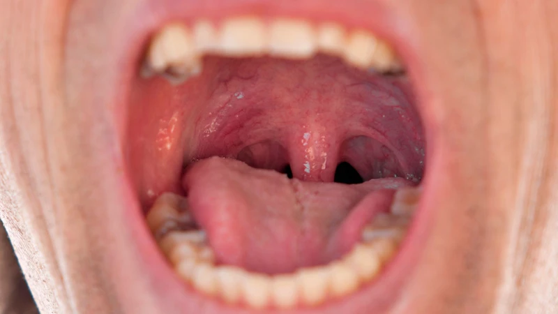 Cấu trúc nhiều khe nhỏ ở họng tạo điều kiện giữ lại cặn và vi khuẩn
