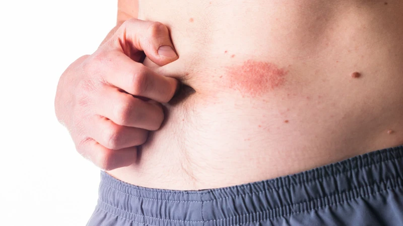 Hồng ban cố định nhiễm sắc​ là gì? Những thông tin quan trọng 3