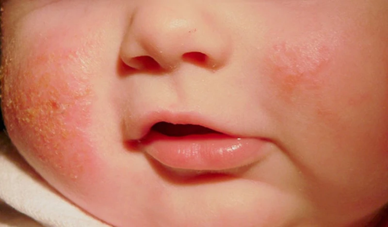 Hướng dẫn cách phân biệt chàm sữa và mụn sữa 2