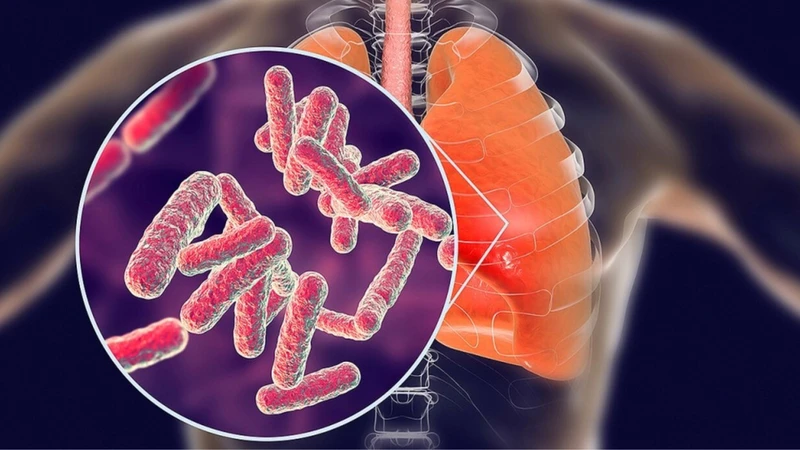 Hướng dẫn cách sống chung với người bị bệnh lao an toàn 1