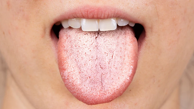 Lưỡi trắng có thể do vệ sinh răng miệng kém, khô miệng hoặc nhiễm nấm Candida