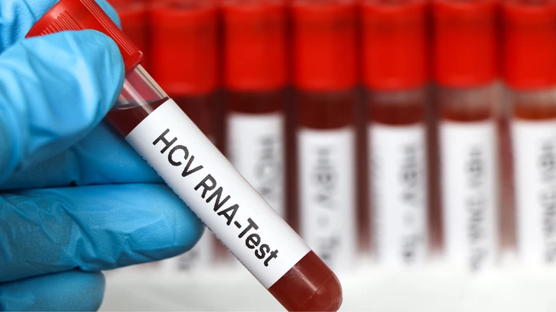Hướng dẫn chi tiết cách đọc kết quả định lượng virus viêm gan C 1