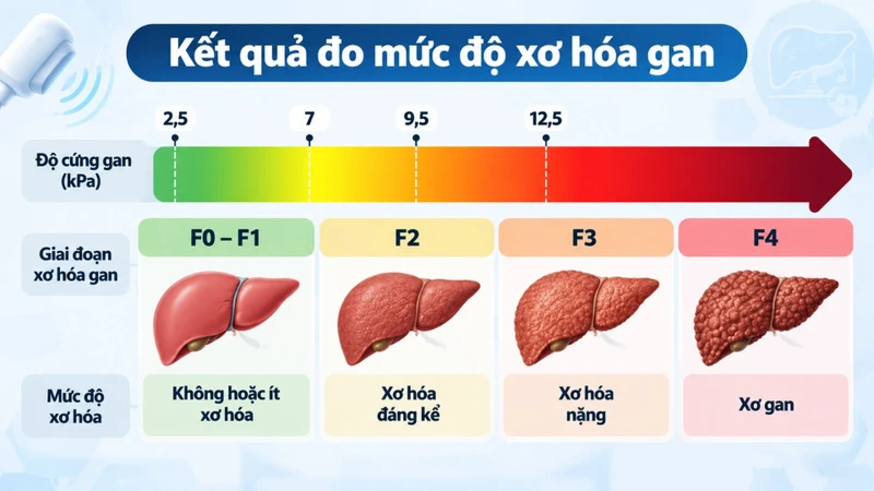 Đo mức độ xơ hóa gan giúp đánh giá tình trạng mô sẹo trong gan