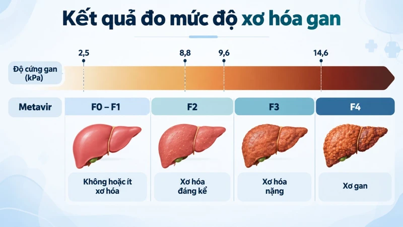 Các giai đoạn xơ hóa gan từ F0 đến F4 phản ánh mức độ tổn thương gan