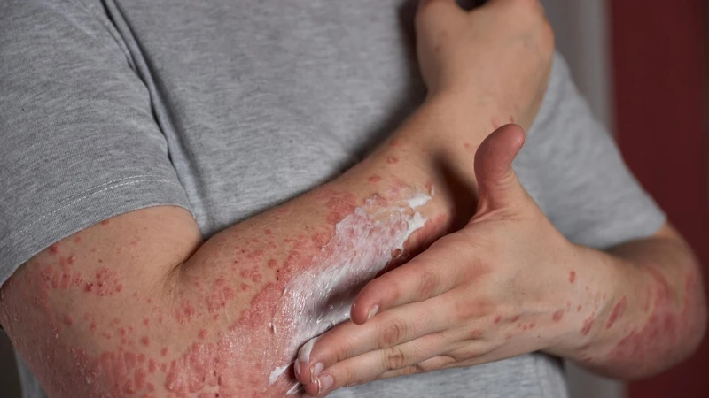 Với người lớn, bệnh Rubella thường diễn ra nhẹ nhàng, tự khỏi sau từ 5 đến 7 ngày với triệu chứng như sốt nhẹ, phát ban và nổi hạch