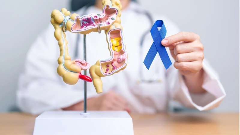 Kết quả sinh thiết polyp đại tràng cho biết điều gì?