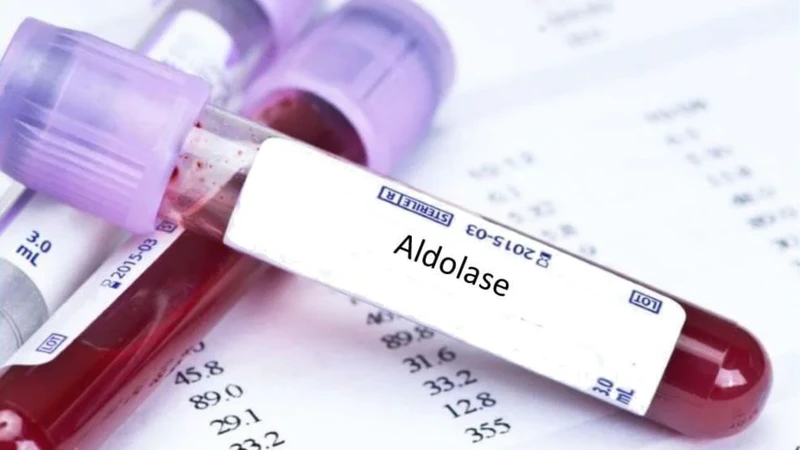 Xét nghiệm đo nồng độ enzyme aldolase là&nbsp;xét nghiệm máu nhằm đo lượng enzyme aldolase có trong huyết thanh