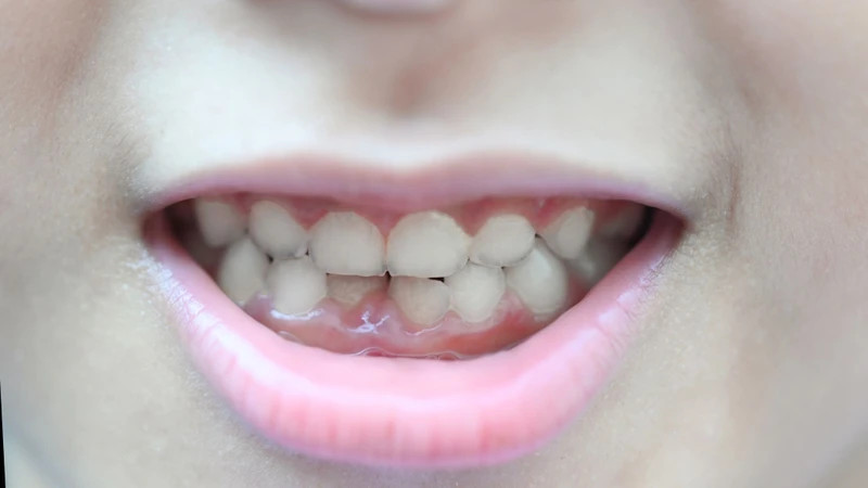 Khi nào trẻ thay răng sữa? Dấu hiệu thay răng ở trẻ 2