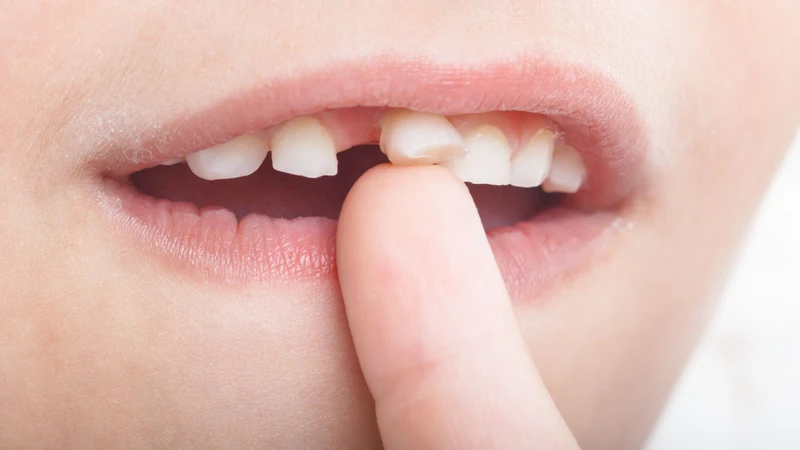Khi nào trẻ thay răng sữa? Dấu hiệu thay răng ở trẻ 3