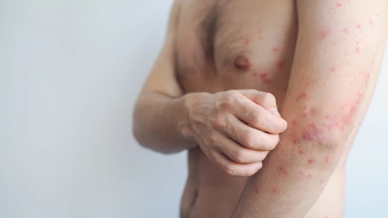 Không lạm dụng su bạc trên diện rộng