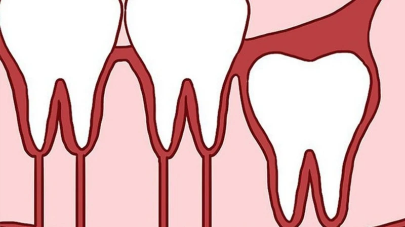 Răng khôn mọc thẳng và không gây đau nhức có thể được cân nhắc không cần nhổ