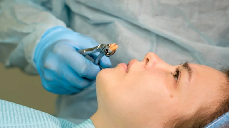 Nha sĩ thường khuyến khích nhổ răng khôn sớm để phòng ngừa biến chứng do răng khôn