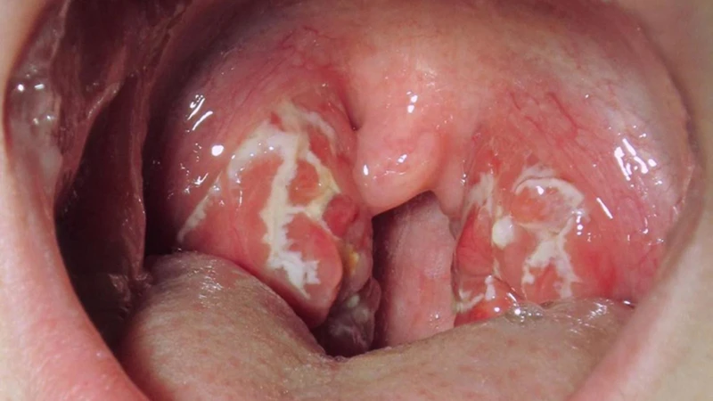 khong-the-chu-quan-truoc-nhung-dau-hieu-nhiem-hpv-o-mieng-1.png