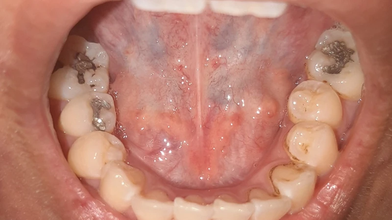 khong-the-chu-quan-truoc-nhung-dau-hieu-nhiem-hpv-o-mieng-3.png
