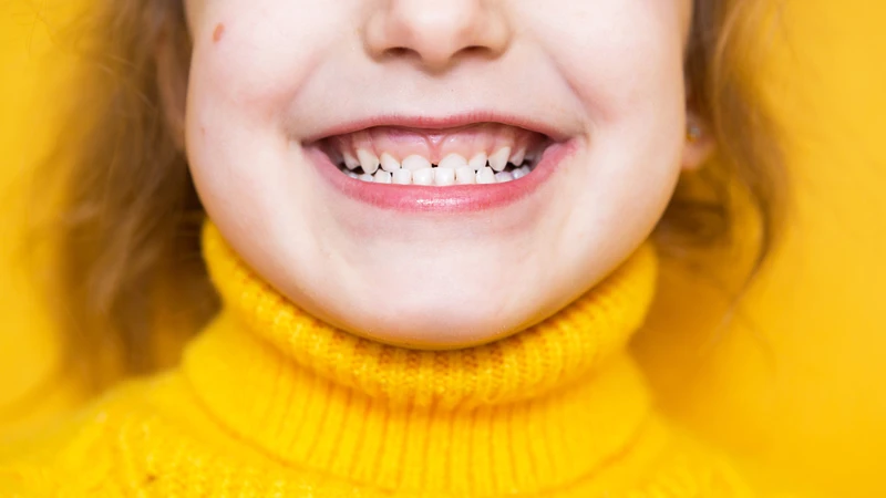 Khớp cắn ngược loại 3: Nhận diện và giải pháp điều trị hiệu quả 1