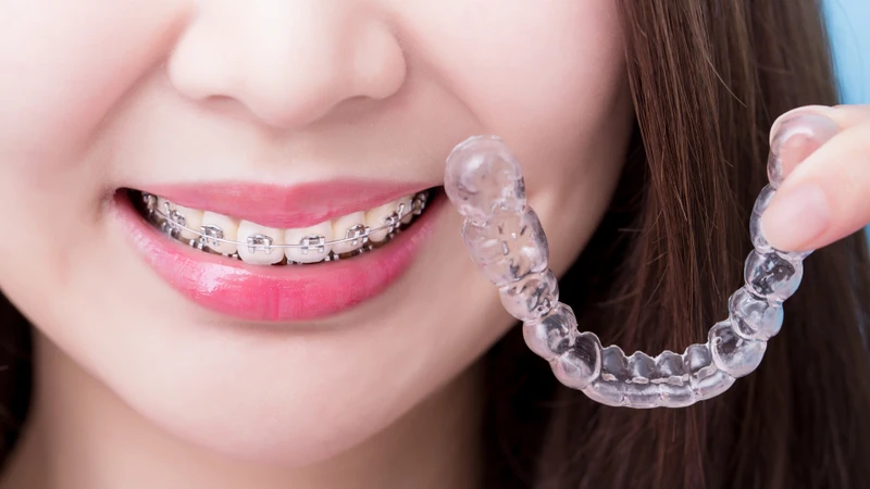 Khớp cắn ngược nhẹ: Tình trạng dễ bị bỏ qua và hệ lụy khó lường 5