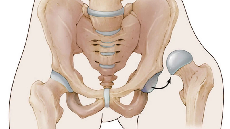 Trật khớp háng là tình trạng mất sự tiếp xúc giải phẫu giữa chỏm xương đùi và ổ cối