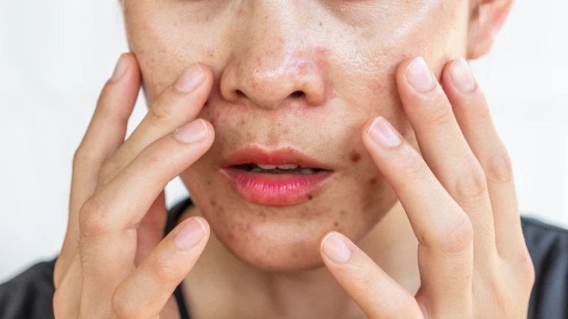 Các bệnh như viêm da tiết bã, trứng cá đỏ, viêm da quanh miệng... thường ghi nhận tỷ lệ Demodex cao hơn
