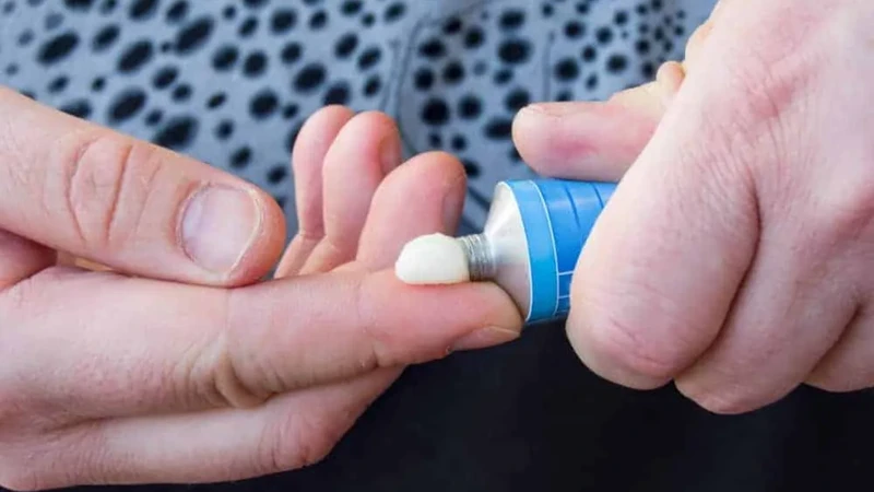 Điều trị lác đồng tiền bằng thuốc chống nấm dạng bôi ngoài da