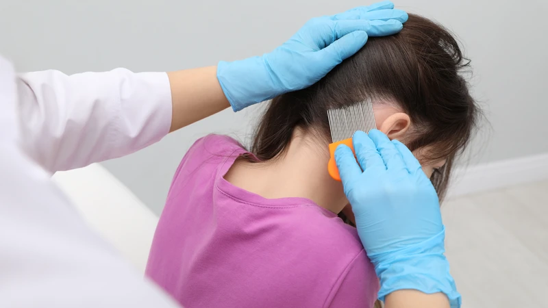 Làm sao để hết chấy và trứng trên đầu trẻ? Dùng lược chuyên dụng để chải chấy là phương pháp cơ học an toàn