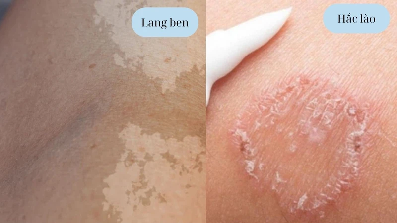 Lang ben hắc lào​ khác nhau ở điểm nào? 3