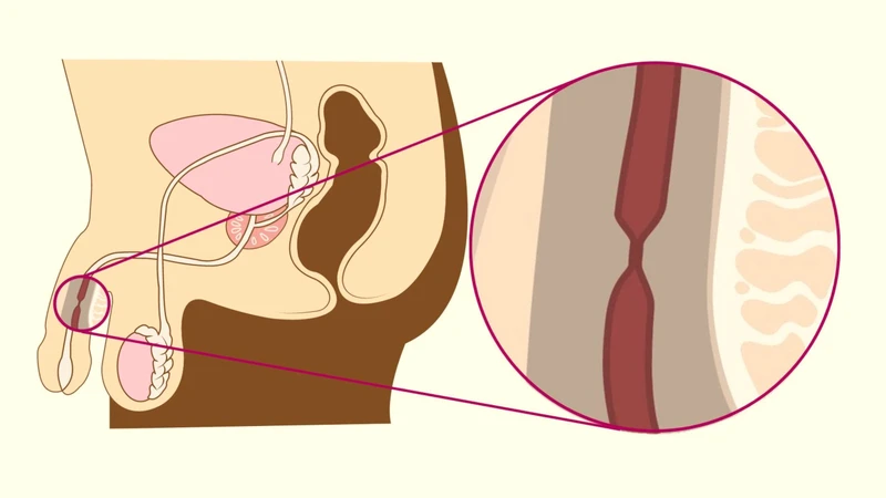 Lao tiết niệu là gì? Những điều cần lưu ý 2.jpg