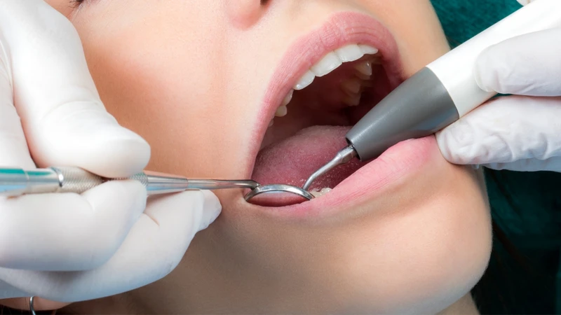Cao răng là môi trường thuận lợi cho vi khuẩn phát triển, từ đó làm tăng nguy cơ viêm nướu, viêm nha chu và sâu răng