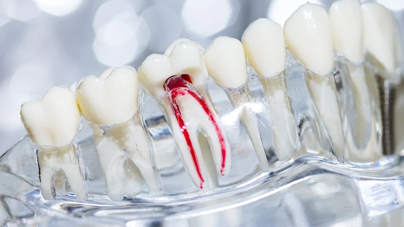 Tủy răng chết hoàn toàn, vi khuẩn lan rộng ra xung quanh làm tiêu xương