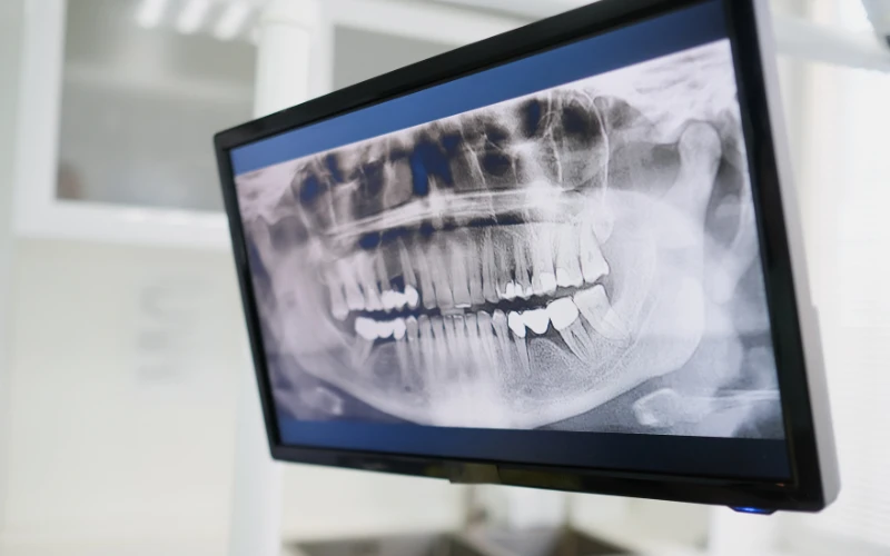 Trước khi lấy tủy, người bệnh có thể được chỉ định chụp X-quang hoặc CBCT để đánh giá tình trạng răng, tủy răng
