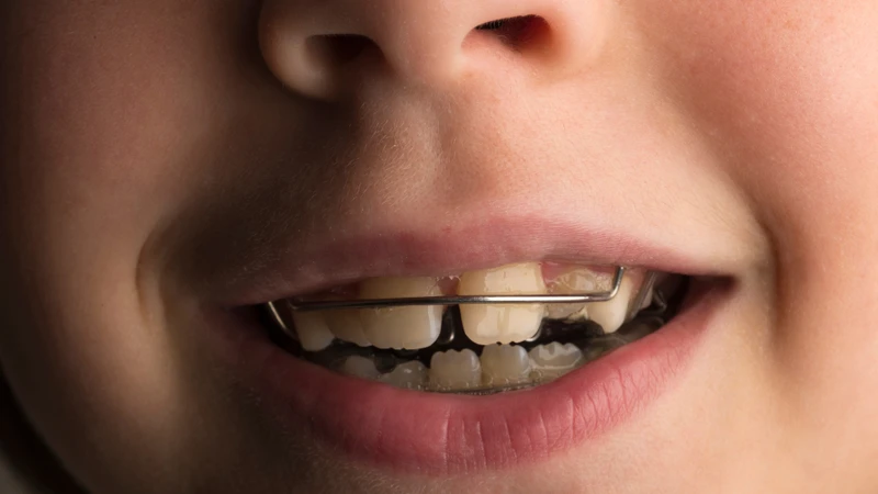 Lệch khớp cắn là gì? Nhận biết, điều chỉnh sớm để tránh lệch mặt - lệch hàm 3