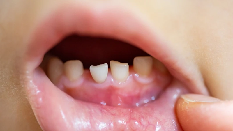 Răng sữa lung lay là dấu hiệu điển hình khi trẻ bắt đầu thay răng sữa