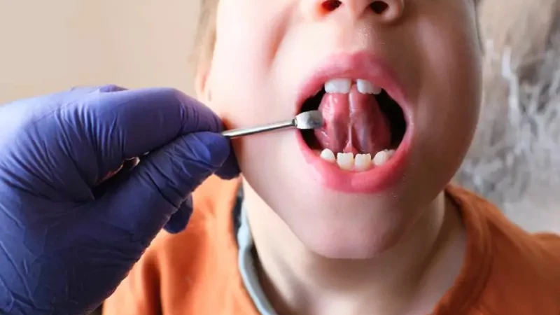 Dính thắng lưỡi là một trong những nguyên nhân phổ biến khiến trẻ bị líu lưỡi và phát âm chưa rõ