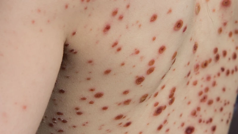Lỡ tiếp xúc với người bị thủy đậu phải làm sao? Cách xử lý đúng
