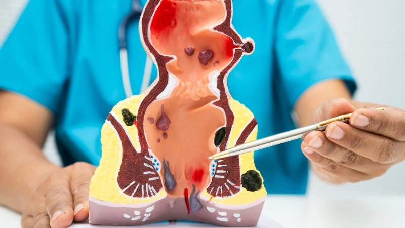 Bệnh trĩ nội ở giai đoạn nhẹ có thể tự co lên sau khi đi vệ sinh