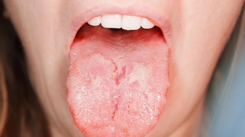 Lưỡi bị nứt thiếu chất gì? Thiếu vitamin nhóm B, sắt và kẽm có thể liên quan