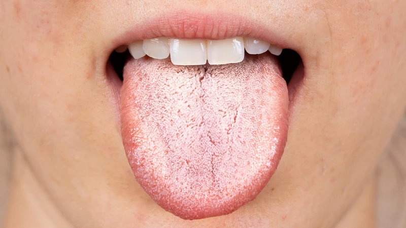Bề mặt lưỡi xuất hiện lớp phủ trắng dày có thể liên quan đến vệ sinh răng miệng kém, nấm miệng hoặc kích ứng niêm mạc