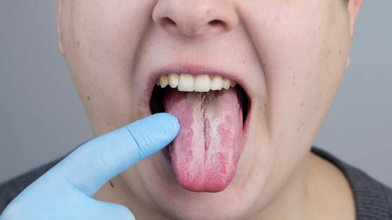Không phải mọi vết trắng trên lưỡi đều là dấu hiệu ung thư