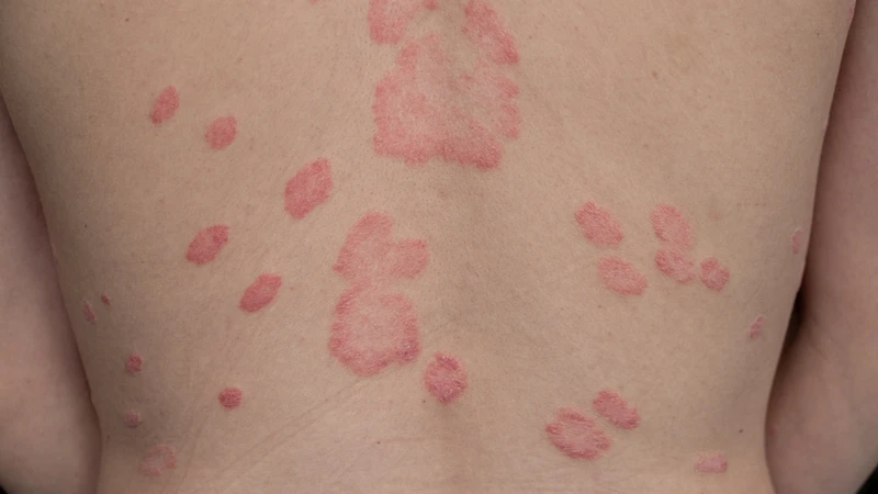 Lupus ban đỏ có ngứa không? Dấu hiệu và cách kiểm soát 2