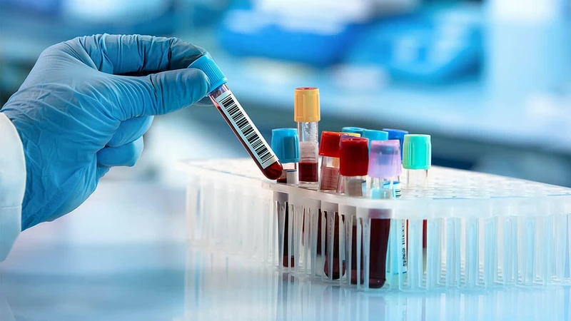 Cần xét nghiệm toàn diện để chẩn đoán lupus ban đỏ dạng đĩa