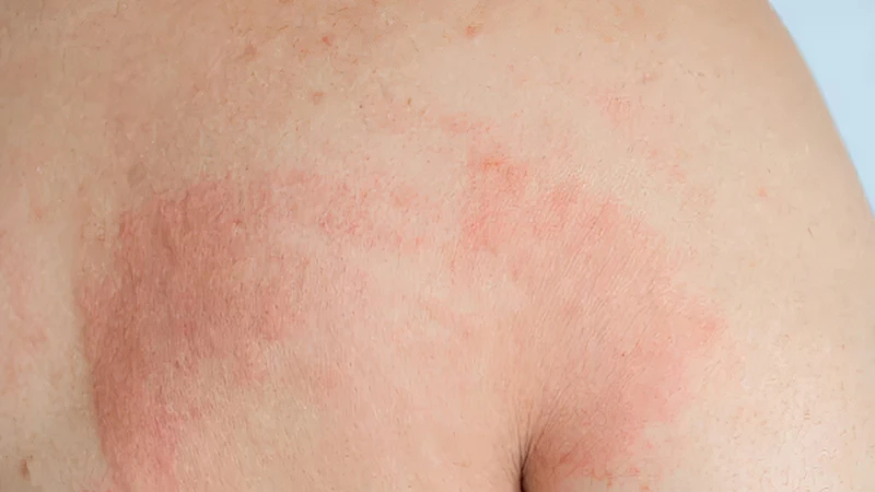 Phát hiện và điều trị sớm giúp người bệnh kiểm soát lupus tốt hơn
