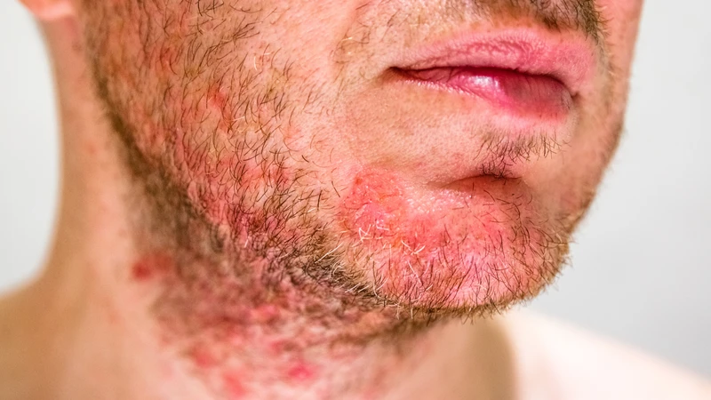 Malassezia furfur kết hợp với yếu tố cơ địa và môi trường trên da, góp phần thúc đẩy viêm da tăng tiết bã