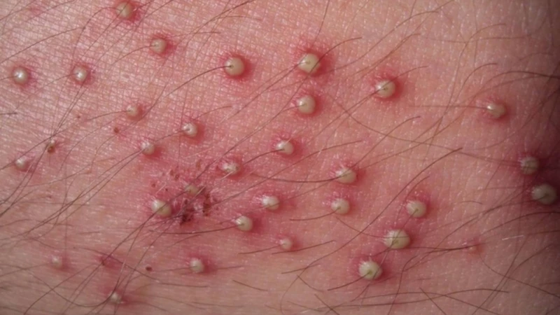 Viêm nang lông do Malassezia gây sẩn nhỏ và mụn mủ quanh nang lông, thường kèm cảm giác ngứa ngáy