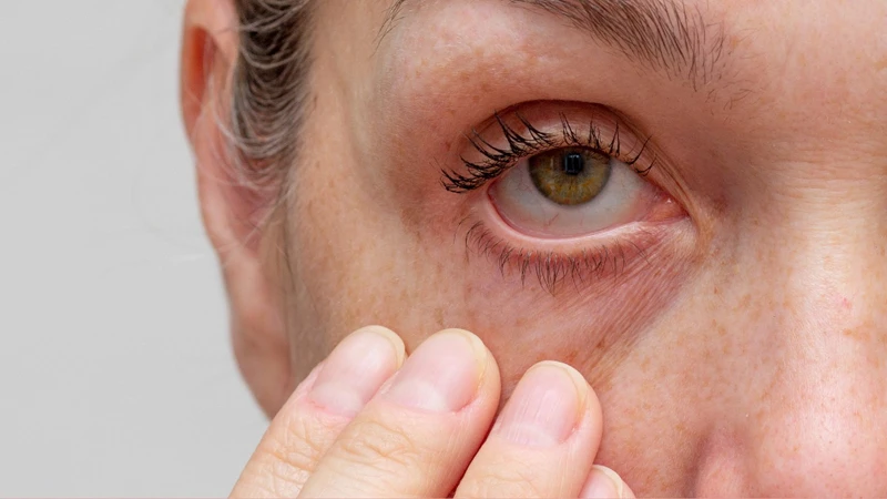 Khô mắt có thể gây cộm, nóng rát và tăng chất nhầy ở mắt