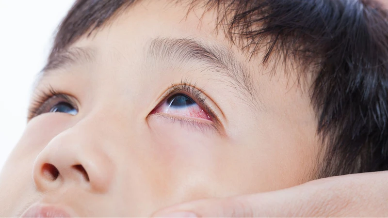 Nổi gân đỏ ở mắt thường đi kèm cảm giác khó chịu và mệt mỏi mắt