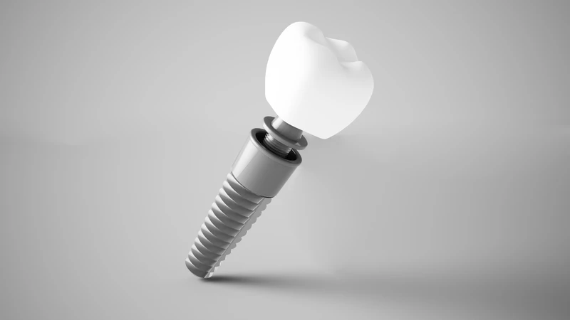 Trồng implant là một trong các phương pháp phục hình răng 7 bị mất