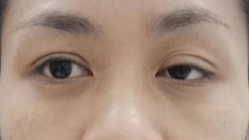 Sụp mí là một trong những nguyên nhân phổ biến gây ra tình trạng mắt không đều