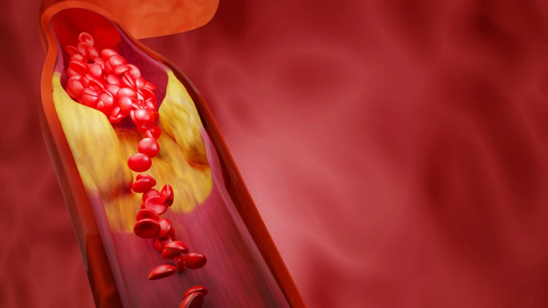 Mỡ máu cao là tình trạng tăng bất thường nồng độ lipid trong huyết tương